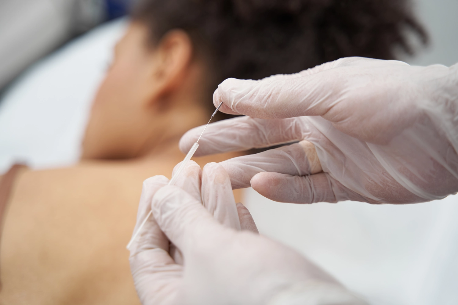 medical worker getting ready for acupuncture sessi 2024 10 18 08 35 39 utc